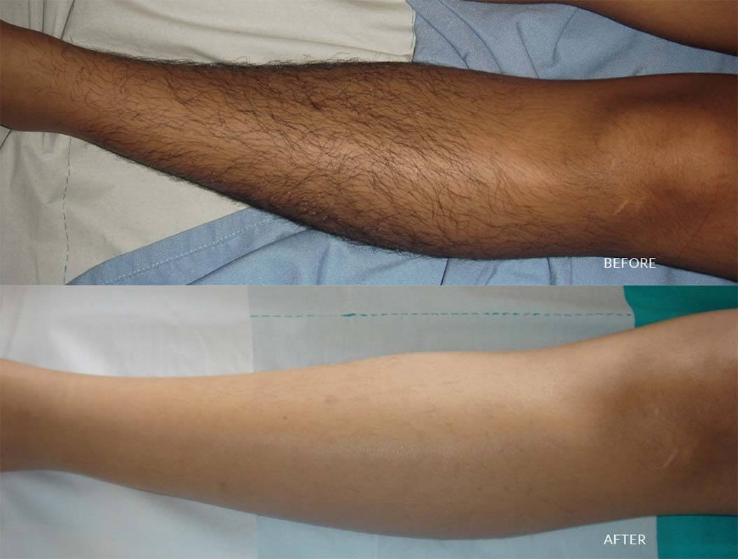skin whitening treatment sri lanka