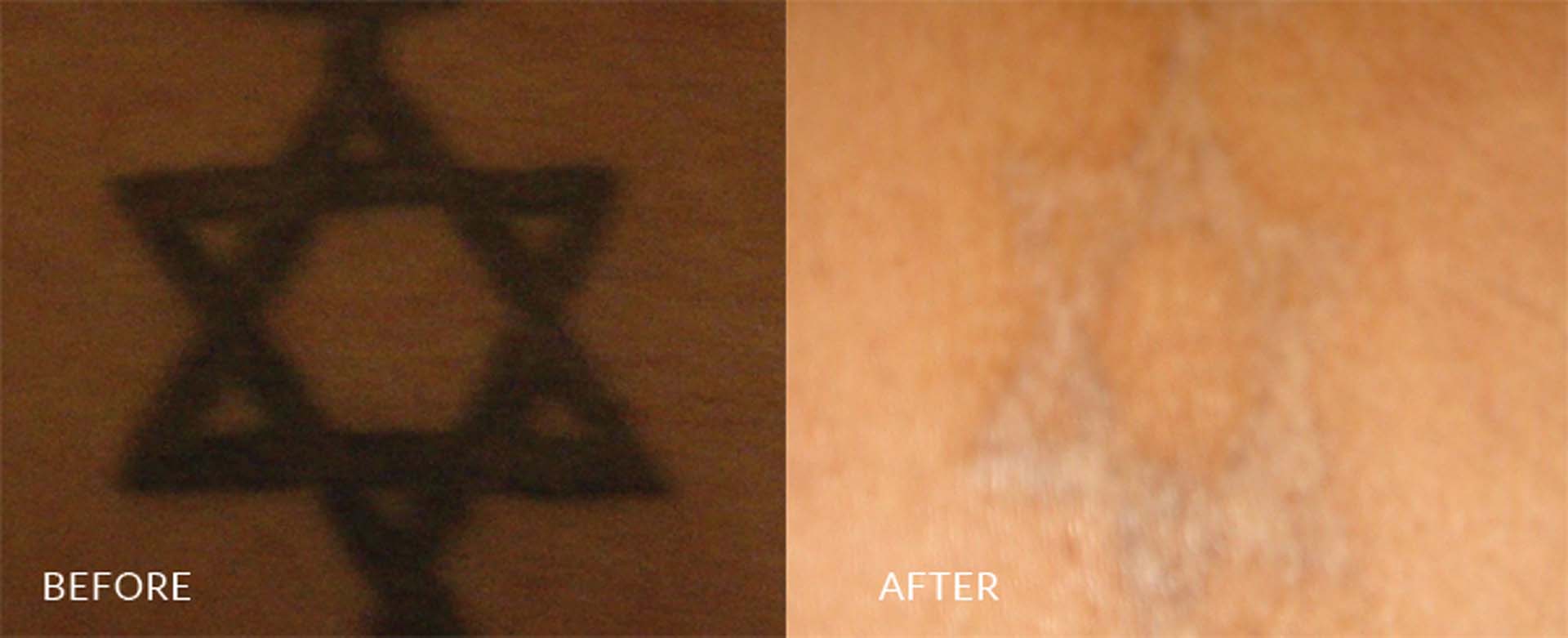 tattoo removal in sri lanka
