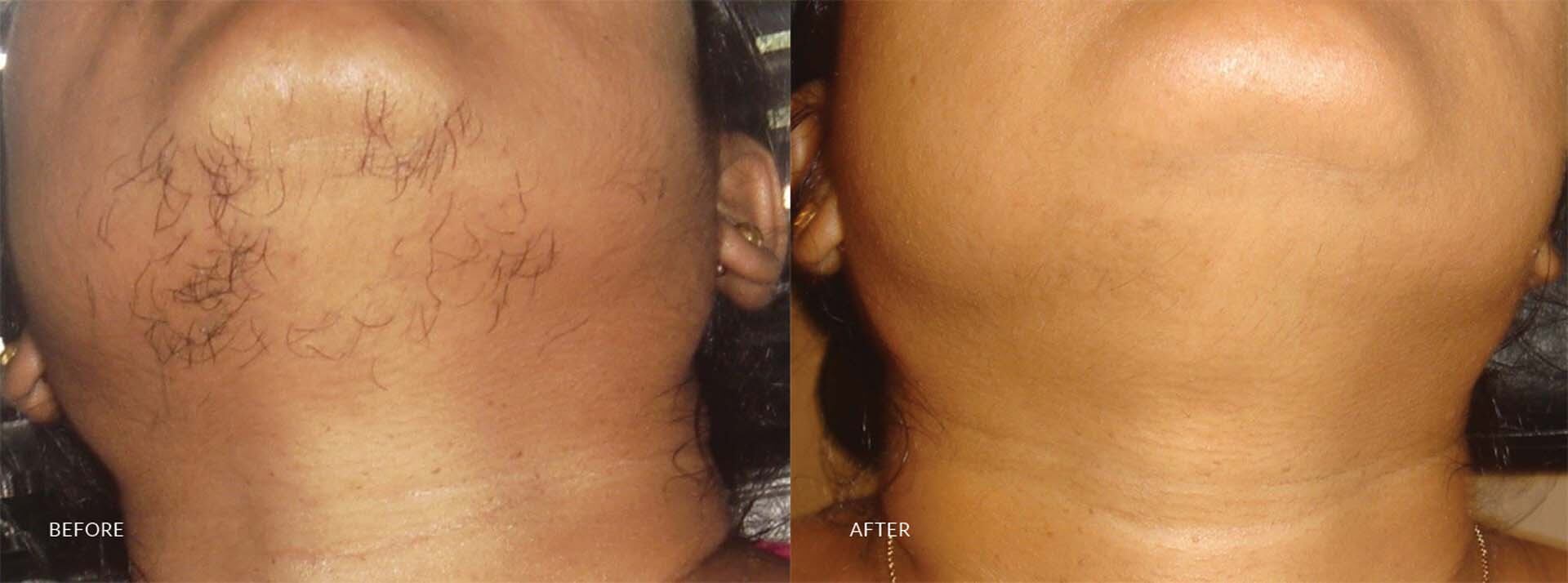 hair transplant in sri lanka