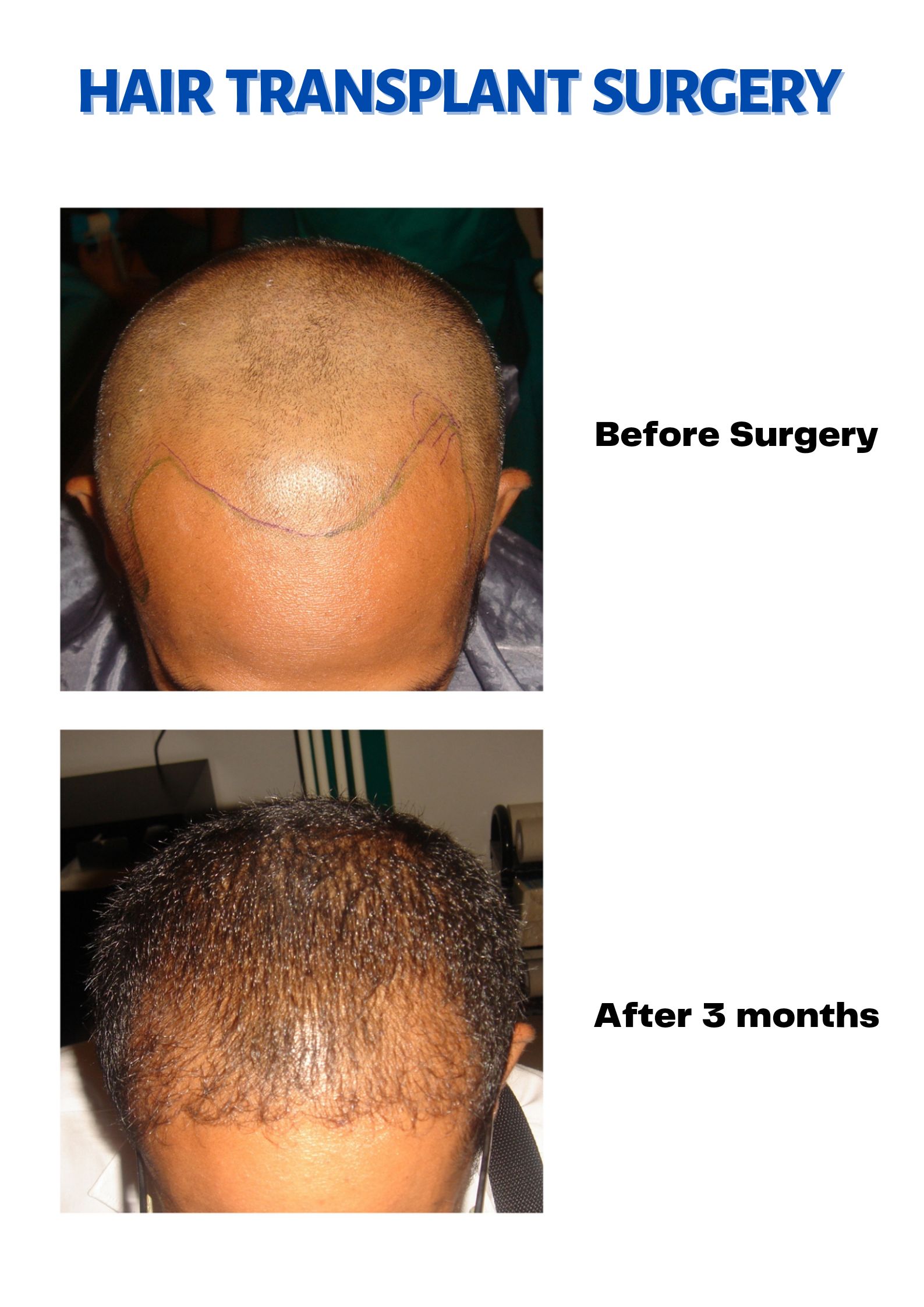 Hair Transplant in sri lanka