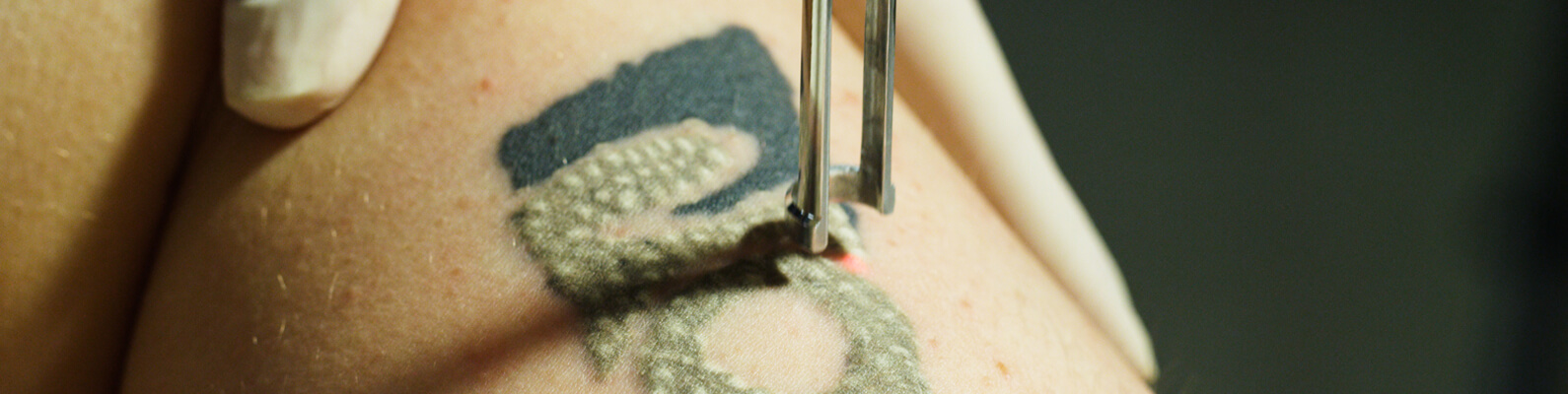 Laser Birth Mark and Tattoo Removal